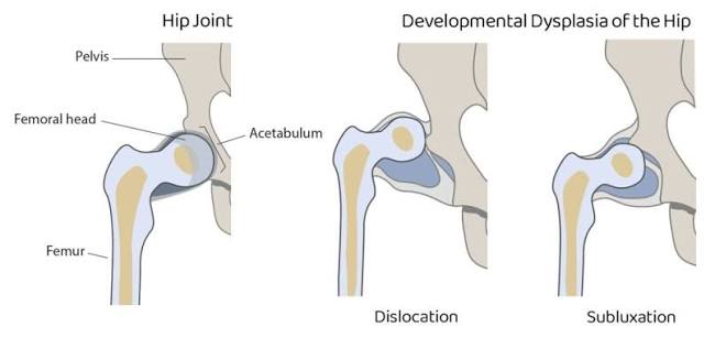 Diagram of hip joint: normal, dislocation, and subluxation in Developmental Dysplasia of the Hip (DDH).