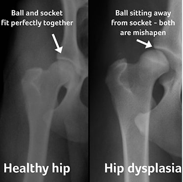 X-rays comparing a healthy hip with normal ball and socket fit to a hip with DDH where the ball is misshapen and sits away from the socket.